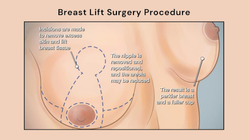 Breast Lift Surgery Procedure